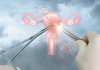Miomas Uterinos