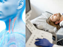 Carotidas